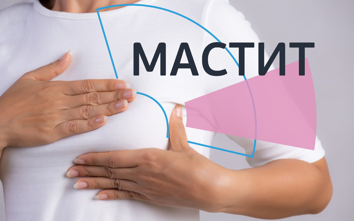 Мастит у женщин: как не пропустить тревожный сигнал и чем помочь себе и своим близким