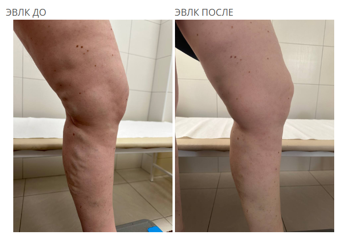 ЭВЛК до и после