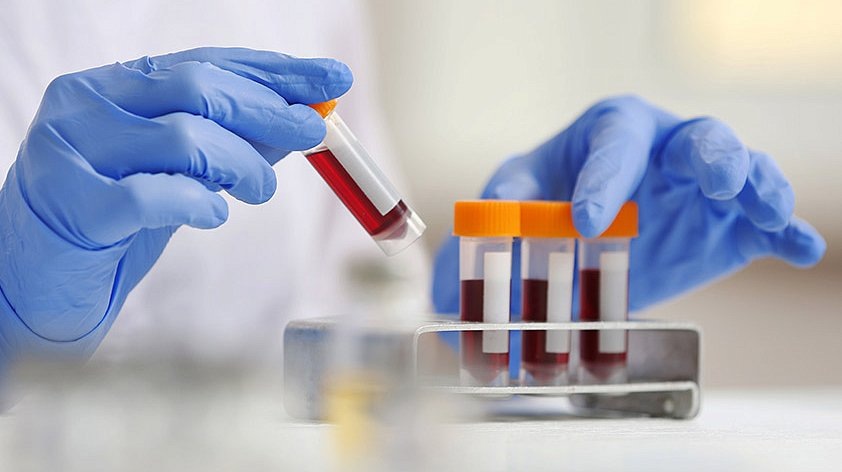 Что на самом деле покажет биохимия крови: 10 болезней, которые видны сразу