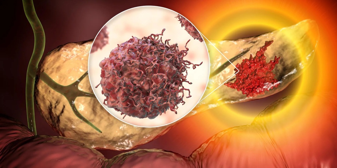 «Коварная кровь»: как простой тест может помочь опередить рак поджелудочной железы