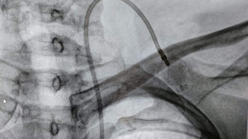 Точно в цель: в Саратовском медицинском центре ФМБА России освоили установку порт-систем для химиотерапии