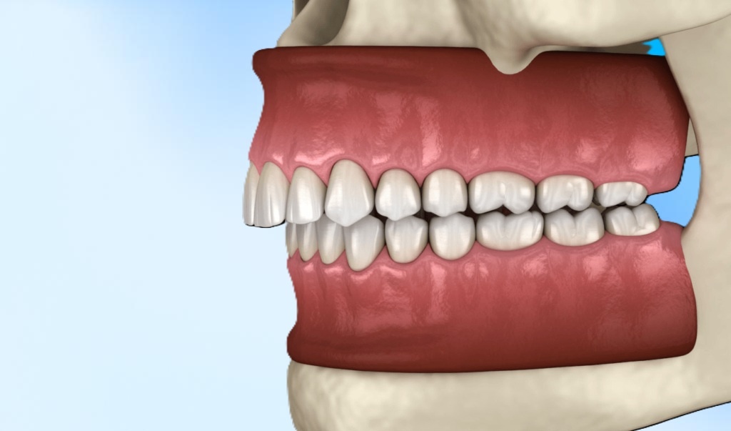 дистальный прикус