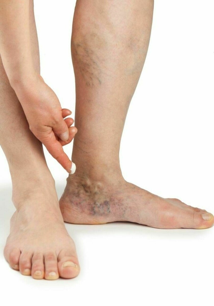     Варикоздан дауа бар