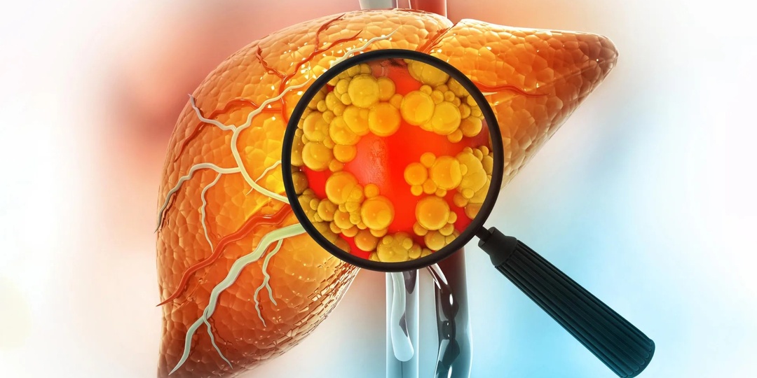 Фермент, который превратил лечение жировой болезни печени в риск рака