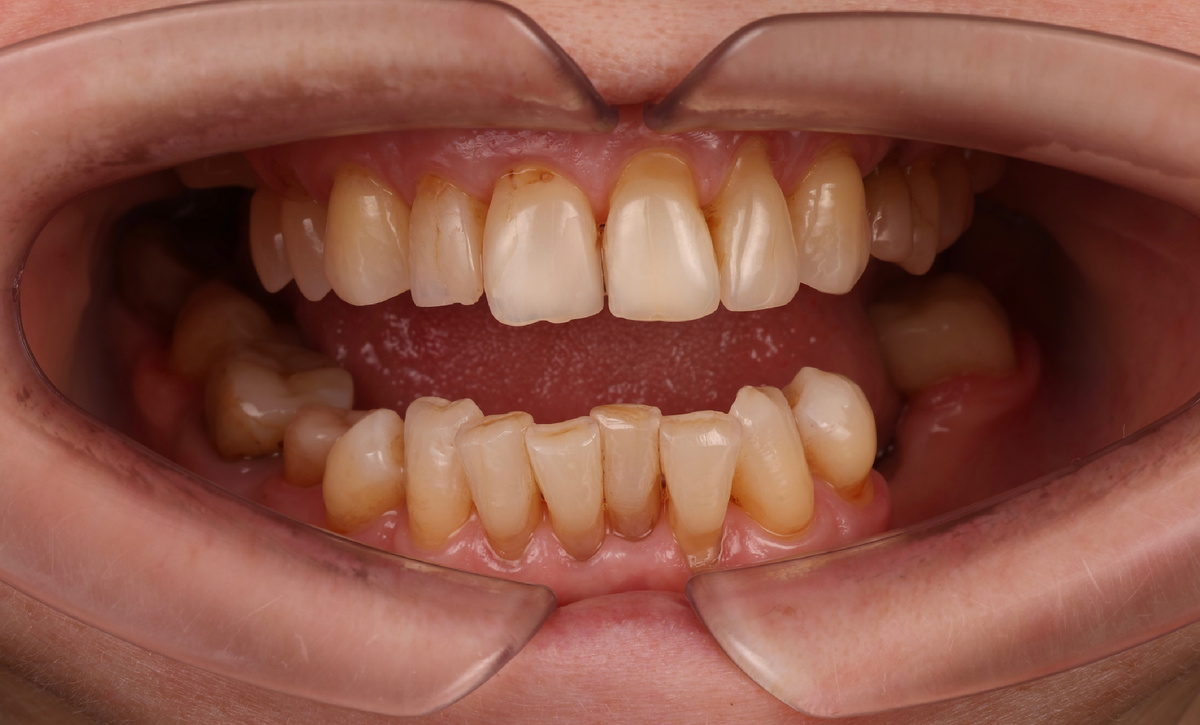 Рецессии, скученность, истираемость, сколы 