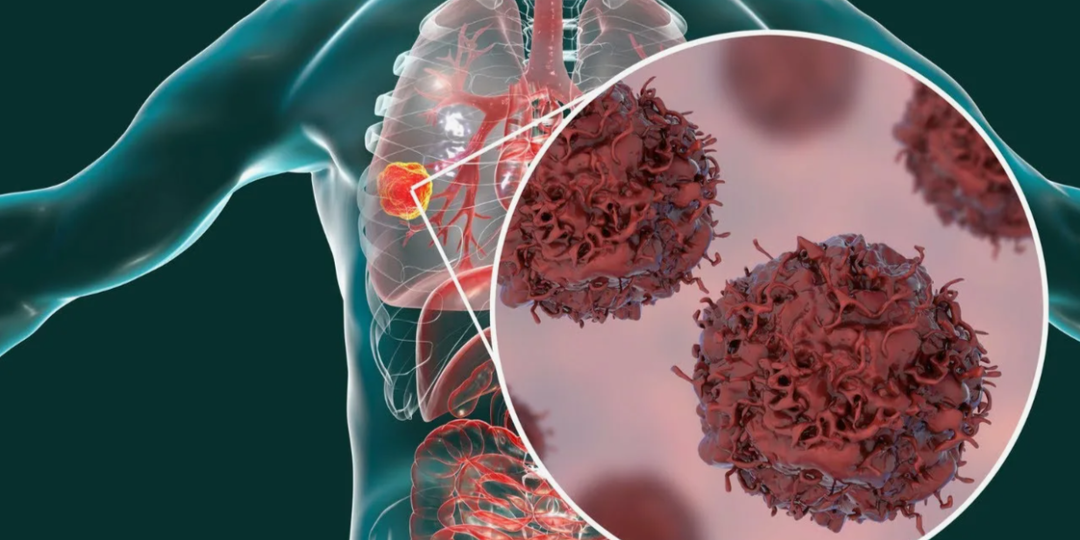 5 видов рака с самым низким процентом выживаемости