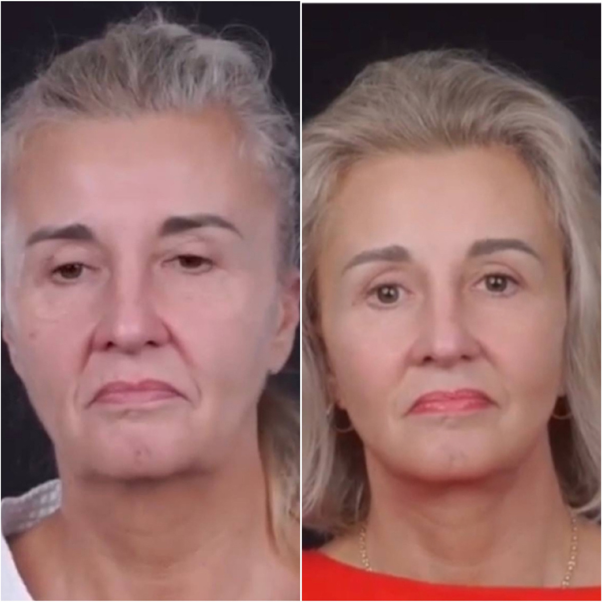 На фото вы видите Валерию, ей 55 лет. По жизни она очень позитивный и энергичный человек. Она сделала подтяжку лица, чтобы убрать обвисшую кожу, разгладить морщины и снова стать молодой. Но даже после пластики ей говорят: «Ты такая серьёзная, что случилось?» В чём подвох? Операция подтянула кожу, но мимические привычки остались прежними.