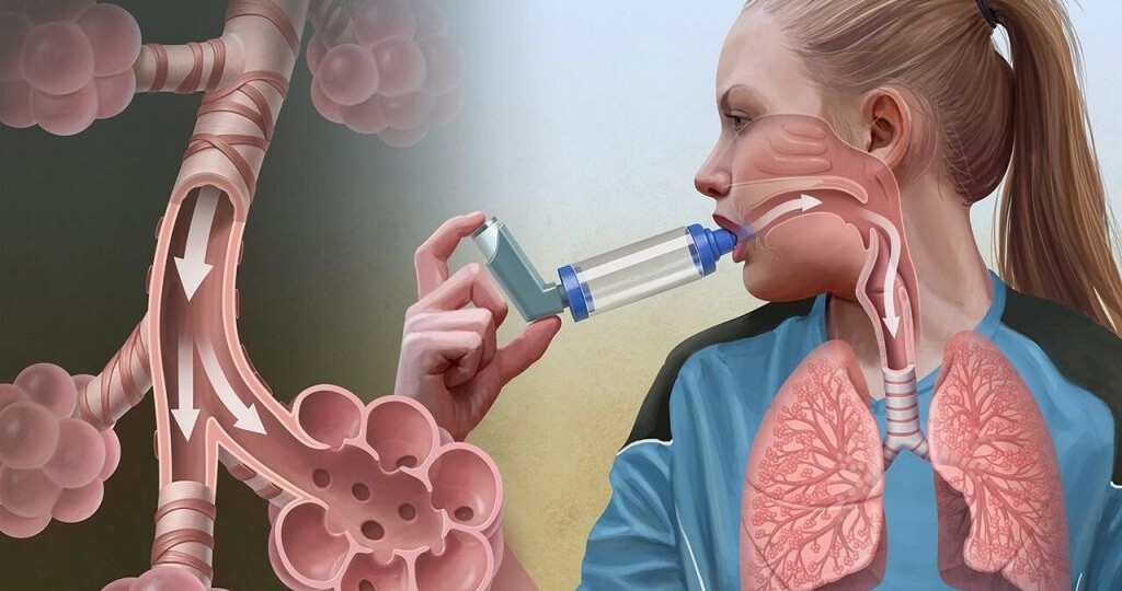 Астма: приговор или контроль? Врач - пульмонолог о диагнозе, ингаляторах и новых методах лечения