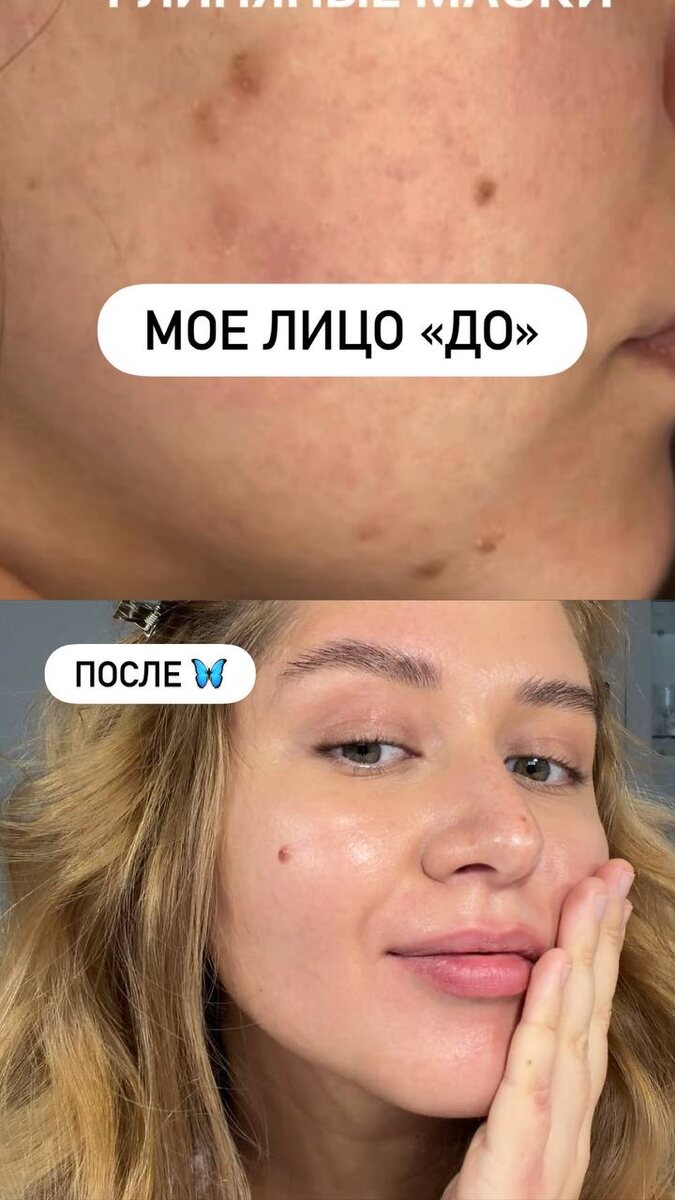 Моя кожа до/после правильного домашнего ухода! Результат сохраняется уже 3 года