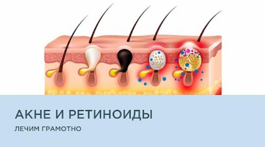 Акне и ретиноиды