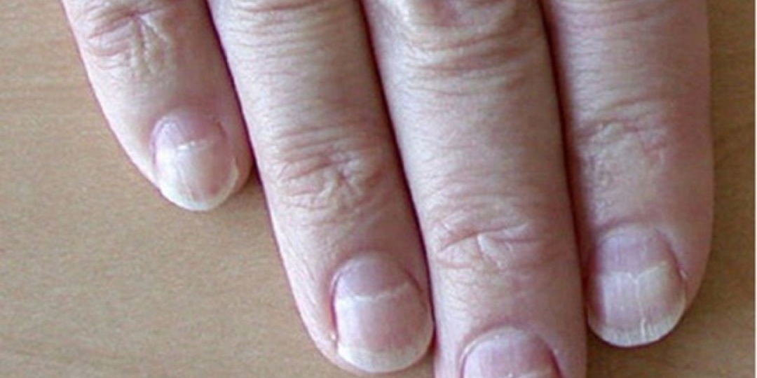 Ногти стали ломкими и тусклыми — какие анализы назначают