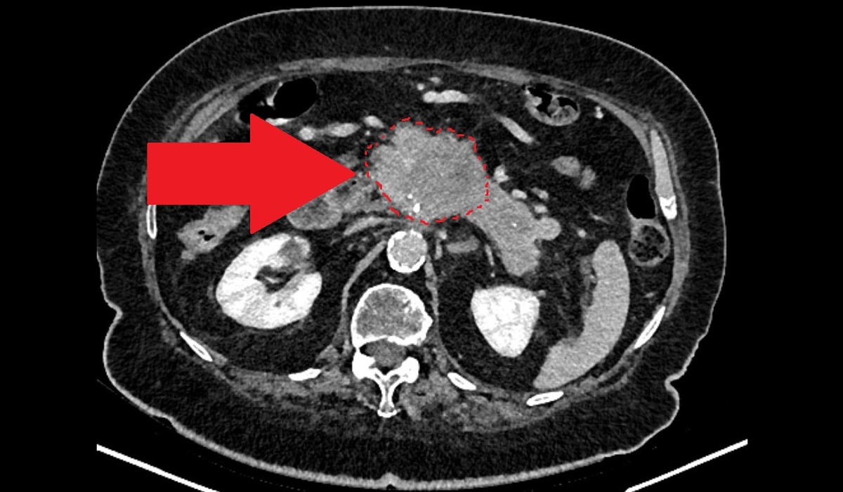 Пунктиром указаны примерные границы опухоли поджелудочной железы.