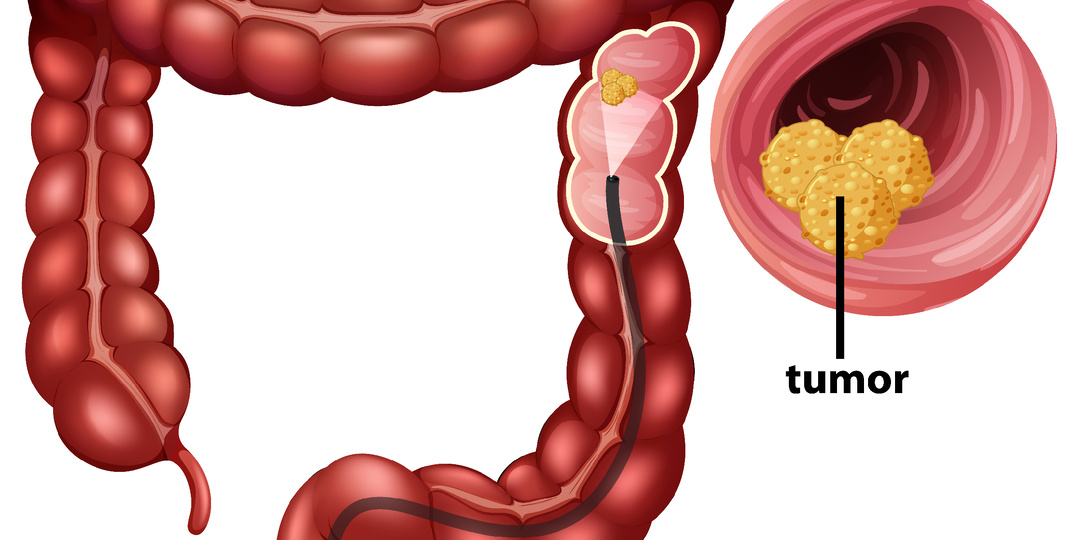 Рак кишечника молодеет: почему диагноз всё чаще ставят до 45 лет