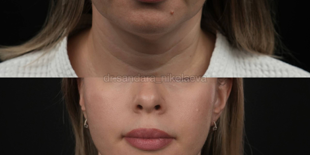 Полгода после фейслифтинга