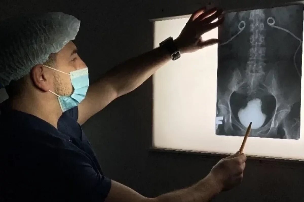    Омские урологи удалили из мочевого пузыря пациентки камень размером с кулак