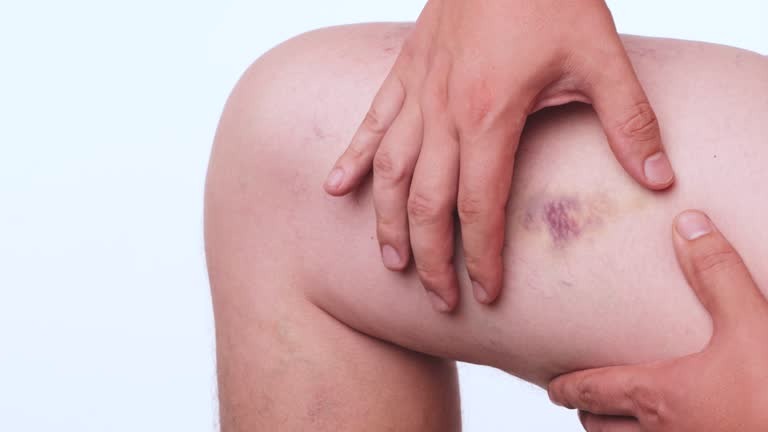 Красная волчанка. Не просто сыпь: история болезни, которую часто не замечают