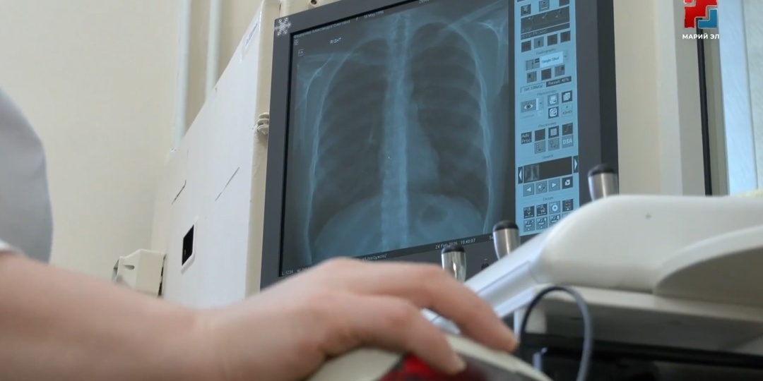 В Марий Эл снизилась заболеваемость туберкулезом