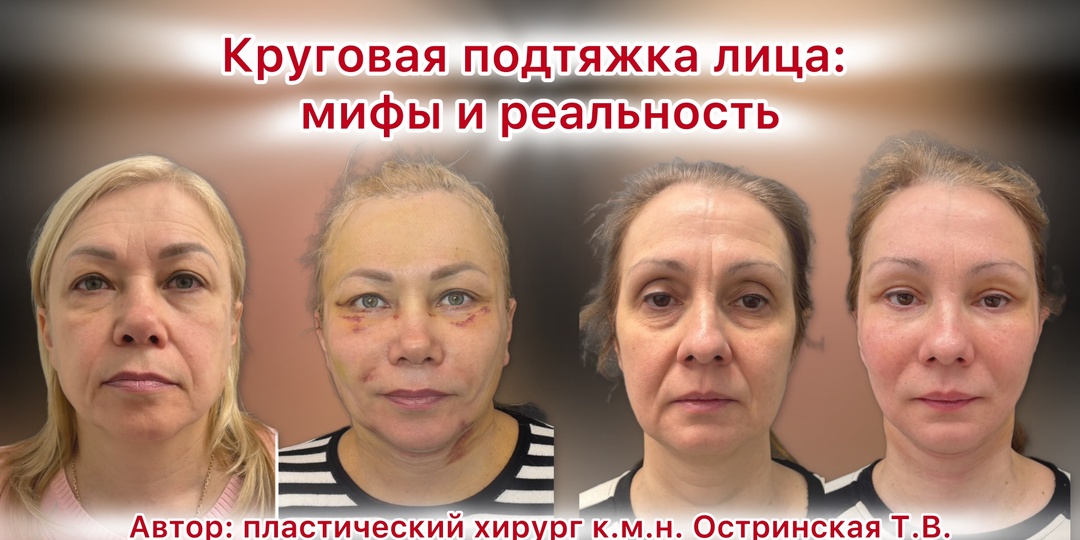 Круговая подтяжка лица: мифы и реальность