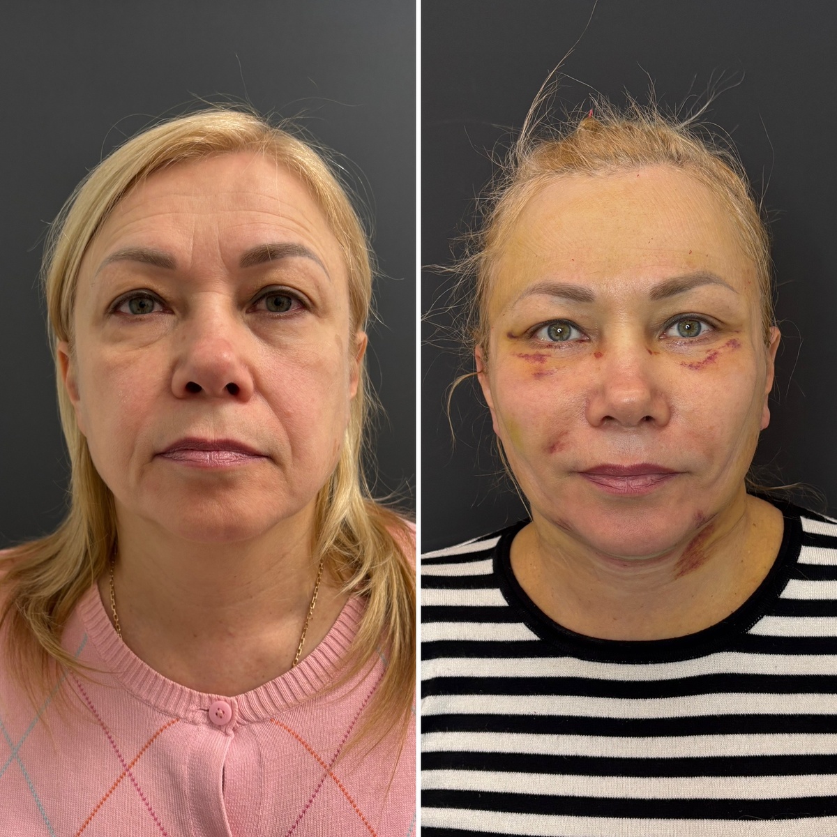 Комплексная операция на лице («круговая подтяжка»)у пациентки 55 лет: 11 дней после операции. Хирург к.м.н. Остринская Т. В. 