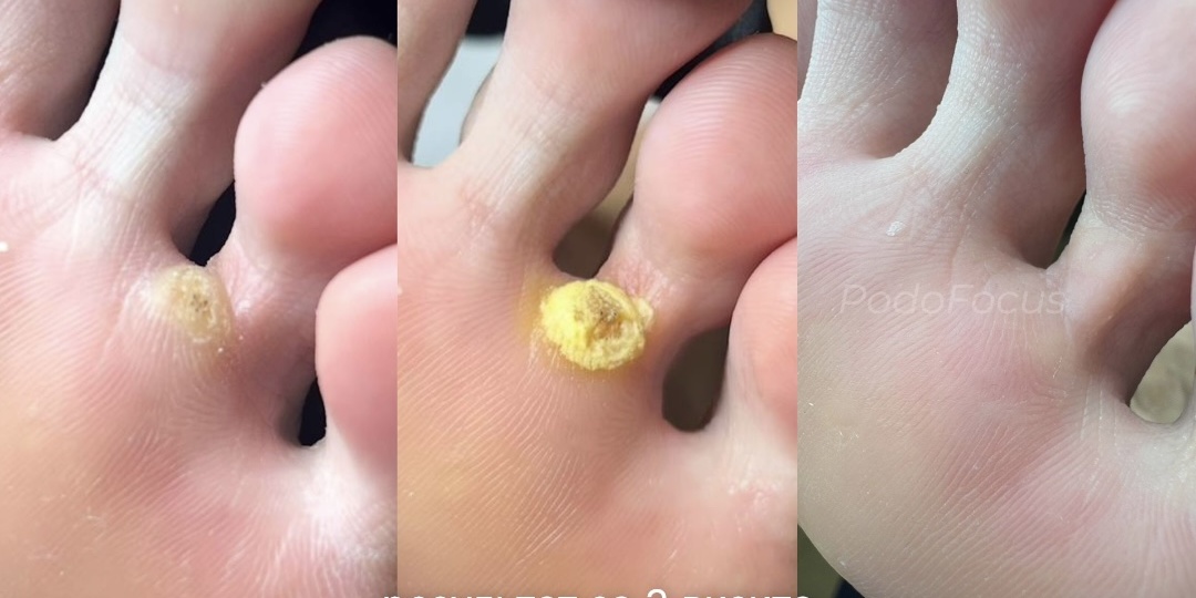 Бородавка: сколько нужно процедур?