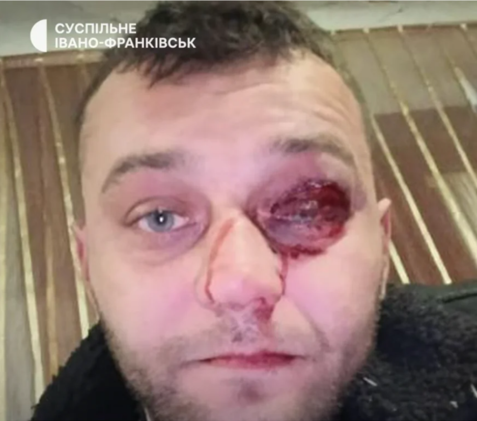    «Ненависть к военнослужащим». В Ивано-Франковской области шестеро односельчан жестоко избили ветерана-инвалида ВСУ