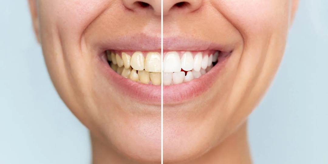 Вибрации против пятен: новая пудра отбеливает и защищает зубы