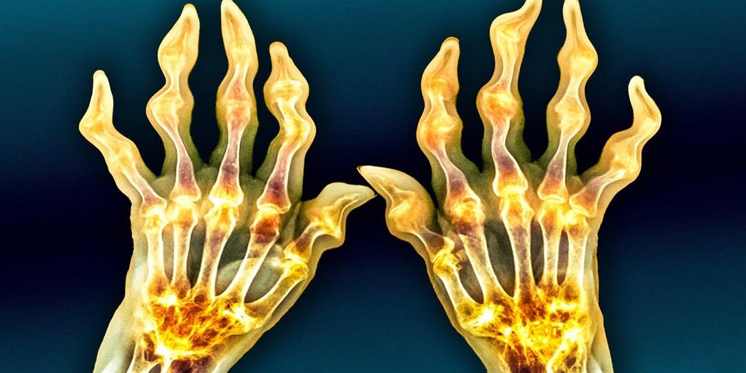 Кристаллы в суставах: как избавиться от избытка мочевой кислоты и вернуть лёгкость движений