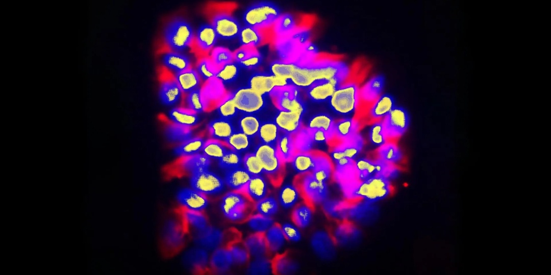 Генная карта метастазов: как ИИ помогает опознать «путешественников»