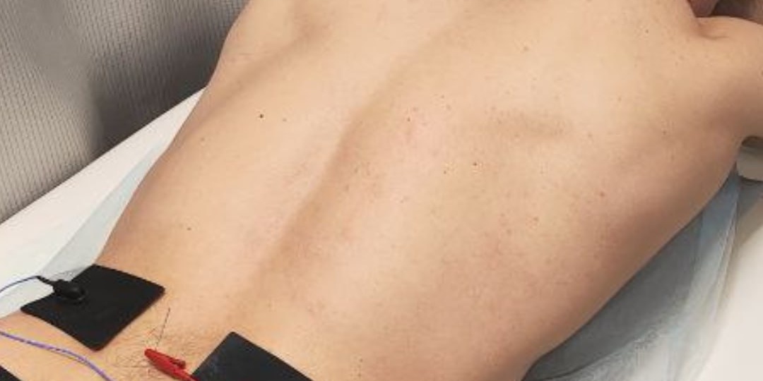 Противоболевая внутритканевая электростимуляция: просто о сложном