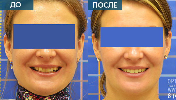 Исправление прикуса до и после, Москва