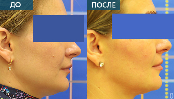 Исправление зубов