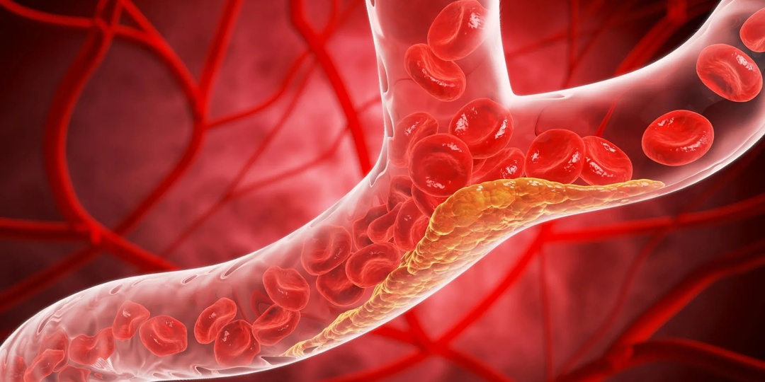 Новая таблетка снижает «плохой» холестерин как никогда раньше — почему это важно?