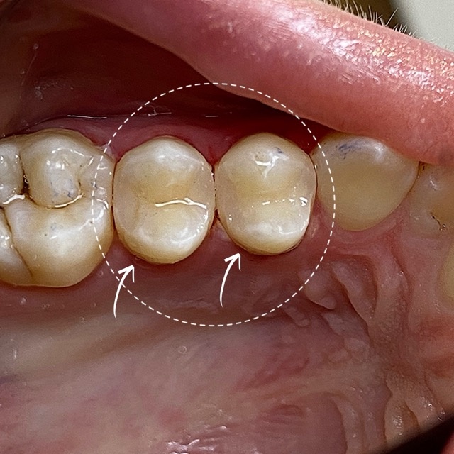 Лечение крытого кариеса зубов 2.4,2.5, который не виден человеческим взгядом