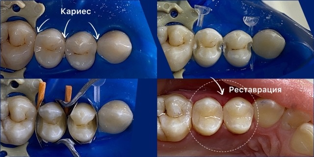 Зачем нужно КТ зубов?