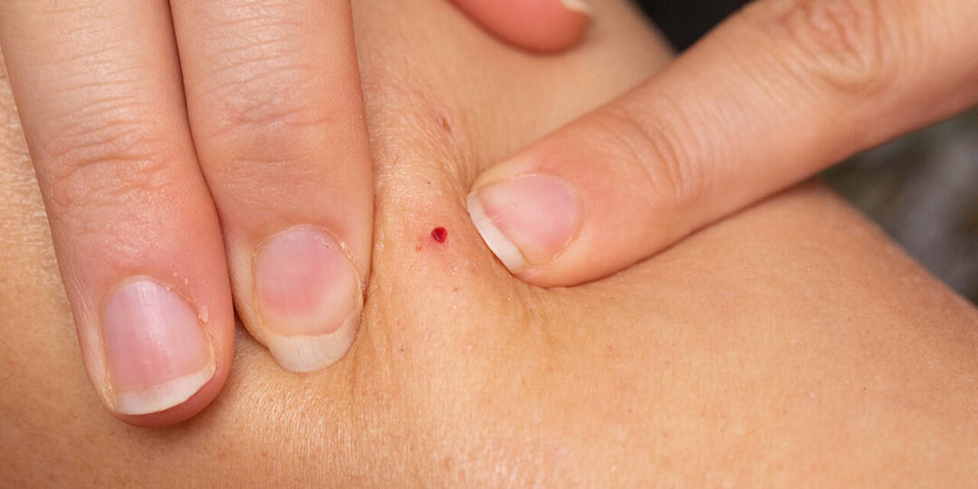 Врачи объяснили, какой признак на коже может быть тревожным