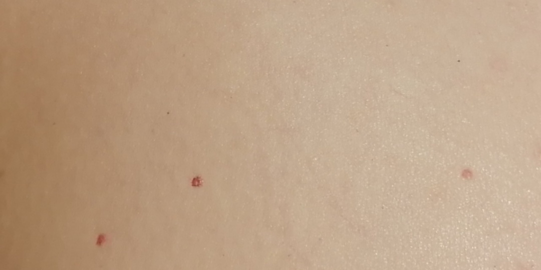 Врачи объяснили, какой признак на коже может быть тревожным