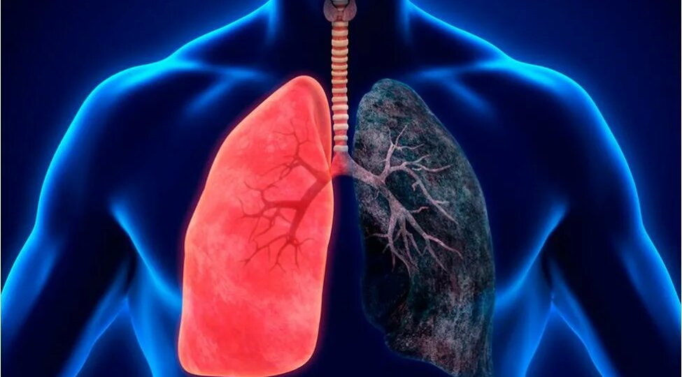 Дышать нечем: как жить с ХОБЛ и почему это не конец света, а новый уровень осознанности