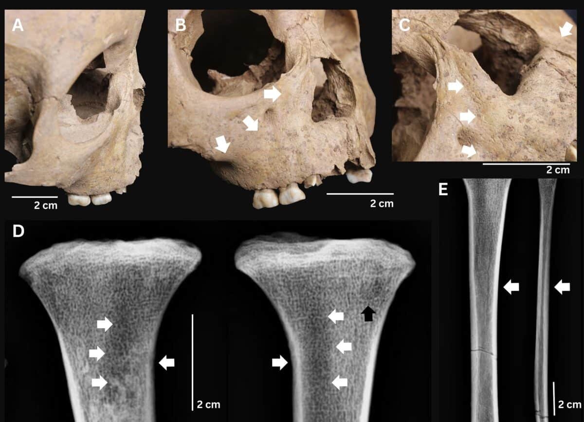    Скелетные изменения, характерные для врожденного трепонематоза: седловидный нос с костным разрастанием, поражение верхней челюсти, а также специфические остеолитические изменения большеберцовой кости на одном из исследованных скелетов / ©The International Journal of Osteoarchaeology