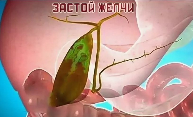 Застой желчи: что делать, если она не хочет выходить