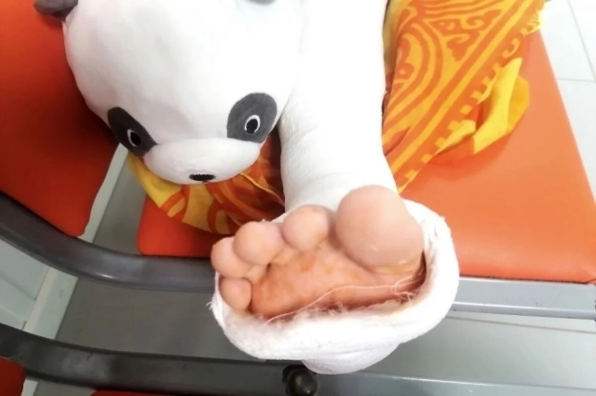    В Твери школьнику пришлось гипсовать ногу после драки с одноклассником