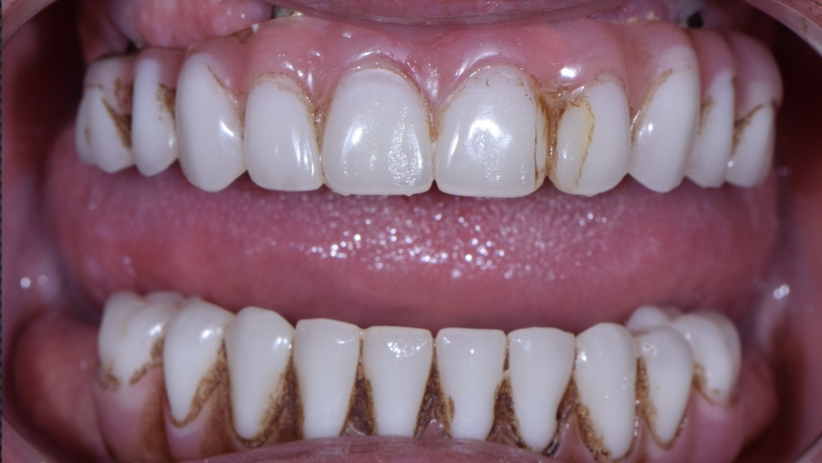 Потемневшие пластмассовые условно-съемные протезы (может снять только доктор). 