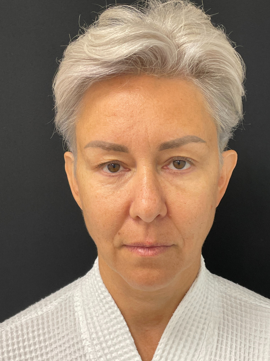 Фото после периорбитопластики: выполнены эндоскопическая подтяжка лба + лифтинг средней трети лица через подресничный доступ. 