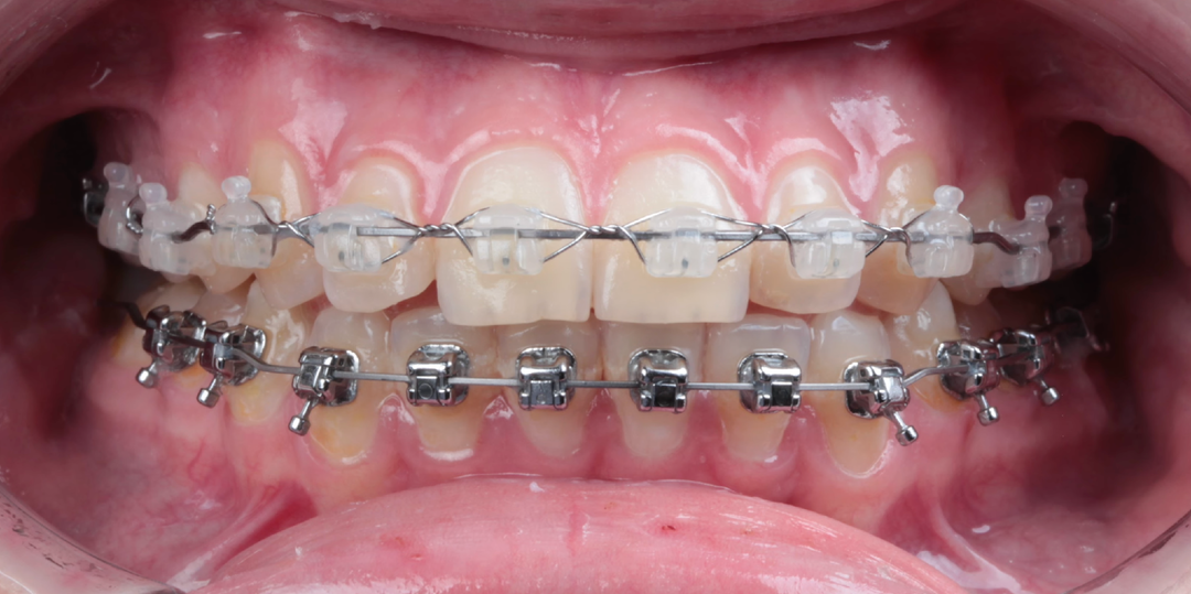 Клинический случай: когда «гнатологическое лечение» становится проблемой