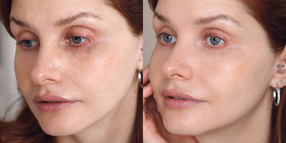 Макияж не понадобится: 2 быстрых шага к идеальной коже вокруг глаз