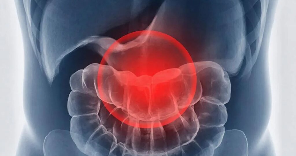 Эти ужины помогут вам при запоре и дивертикулезе