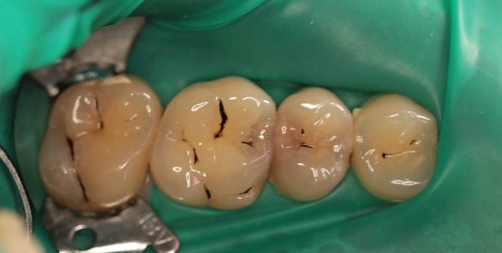 Кажется что кариес на жевательной поверхности, но это не так!