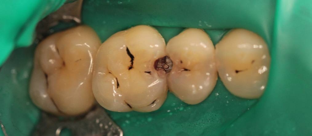 Кариес притаился на контактной поверхности!