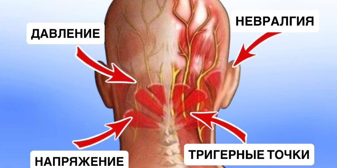 Боль в затылке может быть не такой безобидной: 6 причин, о которых мало кто знает - от давления до синдрома позвоночной артерии
