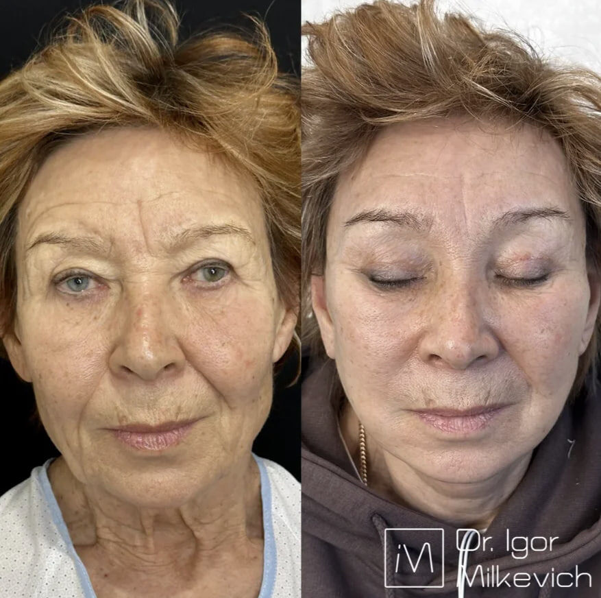 3 недели после операции. 