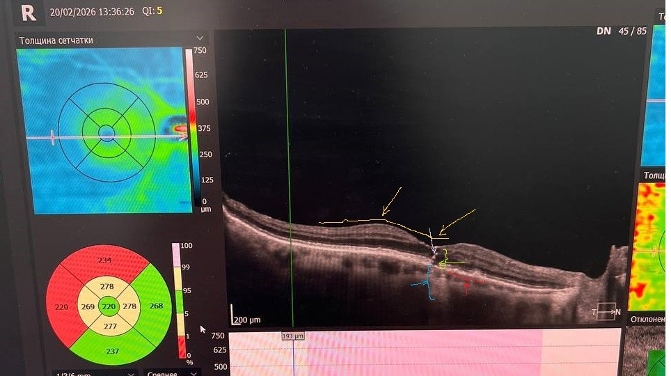 Клинический случай полного макулярного разрыва в сочетании с географической атрофией сетчатки